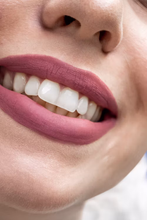 Sonrisa luminosa tras una limpieza y blanqueamiento dental
