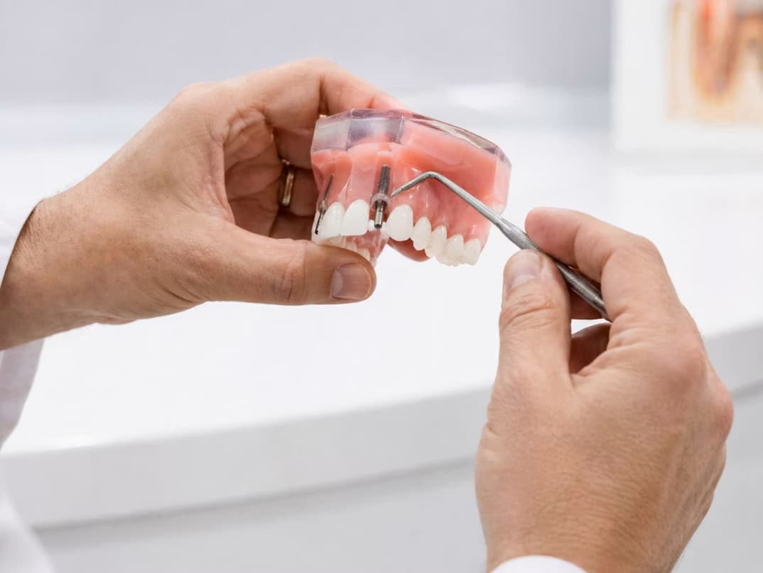 Modelo dental utilizado para explicar los implantes